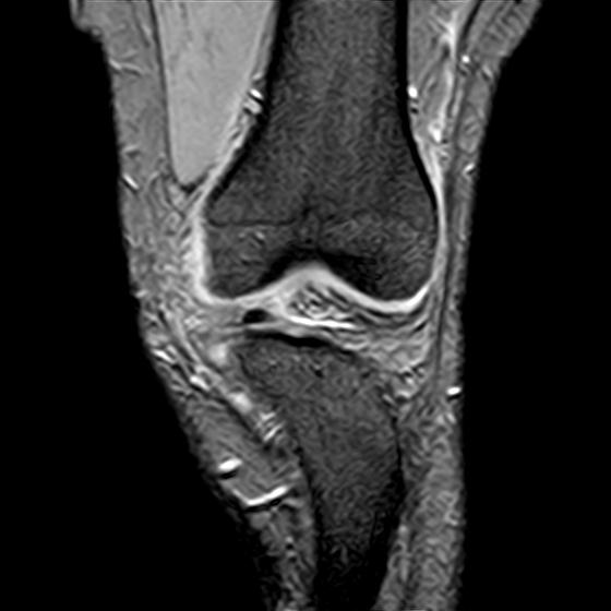 File:Bucket handle tear - medial meniscus (Radiopaedia 29250-29664 B 4).jpg