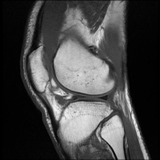 File:Bucket handle tear - medial meniscus (Radiopaedia 69245-79026 Sagittal T1 4).jpg