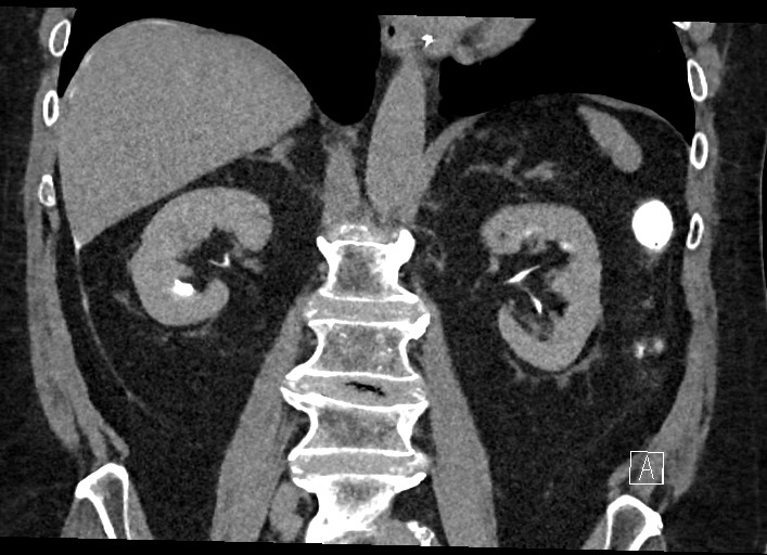 Buried bumper syndrome - gastrostomy tube (Radiopaedia 63843-72577 Coronal Inject 83).jpg