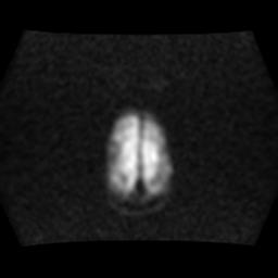 File:Burkitt lymphoma of the orbit- pre and post chemotherapy (Radiopaedia 31214-31929 Axial DWI 16).jpg
