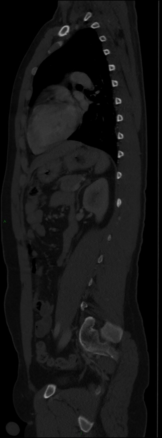 Burst fracture (Radiopaedia 83168-97542 Sagittal bone window 81).jpg