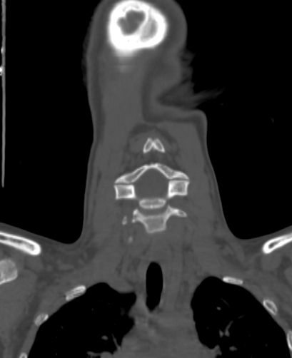 Butterfly vertebra (Radiopaedia 77903-90209 Coronal bone window 15).jpg