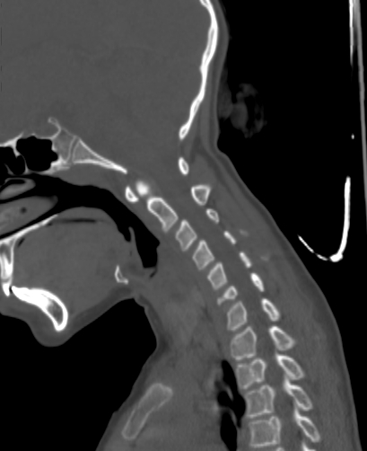 Butterfly vertebra (Radiopaedia 77903-90209 Sagittal bone window 36).jpg