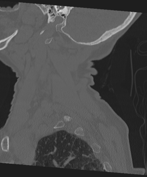 C2 fracture with vertebral artery dissection (Radiopaedia 37378-39199 Sagittal bone window 65).png
