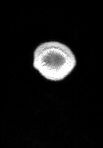 CNS cryptococcosis (Radiopaedia 70895-81108 Coronal T1 C+ 198).jpg
