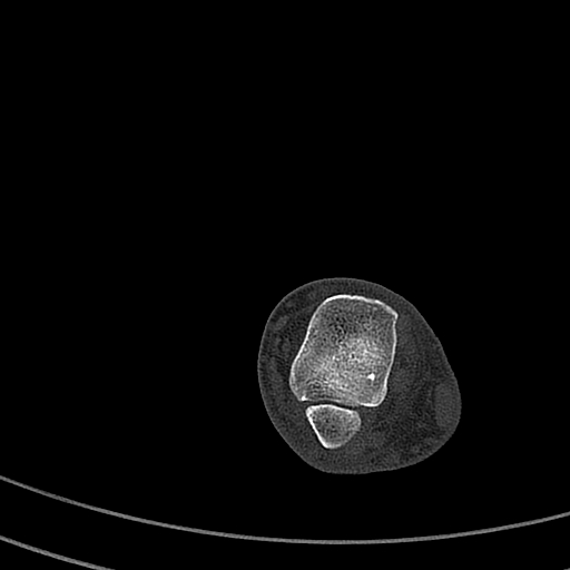 Calcaneal fracture - Sanders type 4 (Radiopaedia 90179-107370 Axial bone window 19).jpg