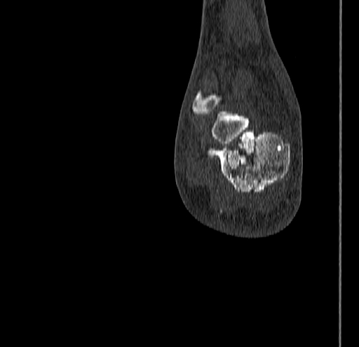 Calcaneal fracture - Sanders type 4 (Radiopaedia 90179-107370 Coronal bone window 77).jpg