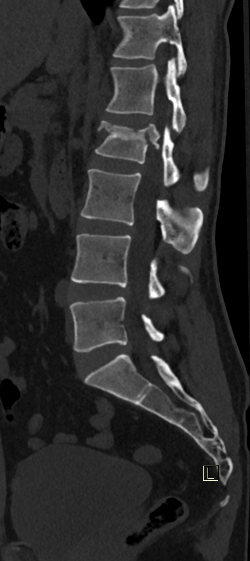 Calcaneal fractures with associated L2 burst fracture (Radiopaedia 71671-82493 Sagittal bone window 40).jpg