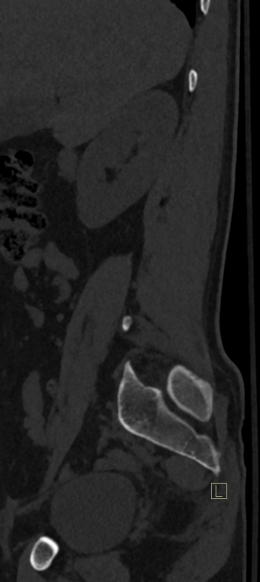 Calcaneal fractures with associated L2 burst fracture (Radiopaedia 71671-82493 Sagittal bone window 76).jpg