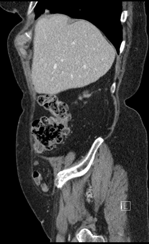 Calcified adrenal glands and Spigelian hernia (Radiopaedia 49741-54988 C 135).jpg