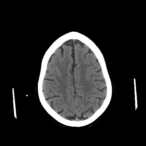 File:Calcified meningioma - cervical canal (Radiopaedia 70136-80171 Axial non-contrast 20).jpg