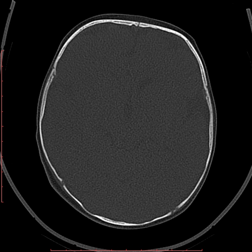 Calcified middle cerebral artery embolism (Radiopaedia 78949-91860 Axial bone window 26).jpg