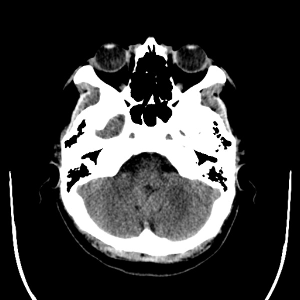 Calvarial osteoma (Radiopaedia 36520-38079 Axial non-contrast 12).jpg