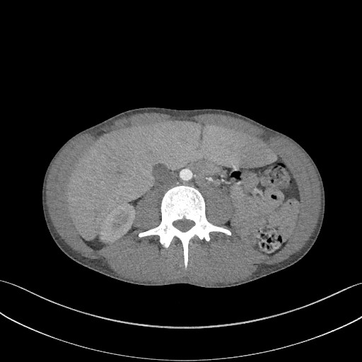 Cannonball metastases - testicular choriocarcinoma (Radiopaedia 84510-99891 B 135).jpg