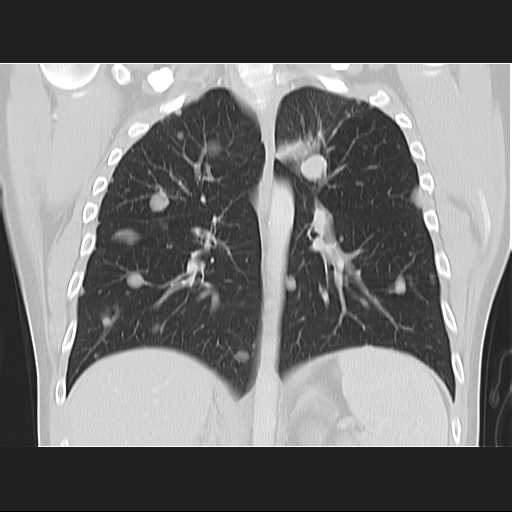 File:Cannonball pulmonary metastases (Radiopaedia 67684-77101 C 15).jpg
