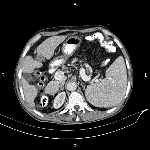 Caput medusae sign - portal hypertension (Radiopaedia 64007-72759 A 20).jpg