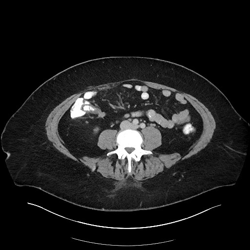 File:Carcinoid tumor - terminal ileum (Radiopaedia 60931-68739 Axial 22).jpg