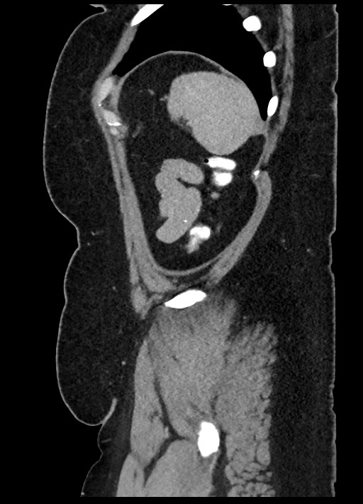 Carcinoid tumor - terminal ileum (Radiopaedia 60931-68739 C 3).jpg