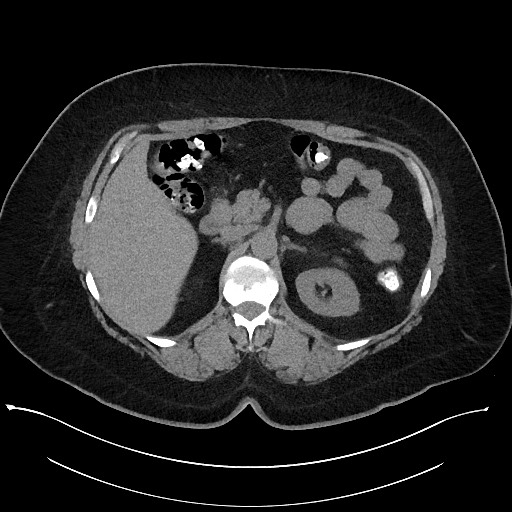 Carcinoid tumor - terminal ileum (Radiopaedia 60931-68740 Axial non-contrast 33).jpg