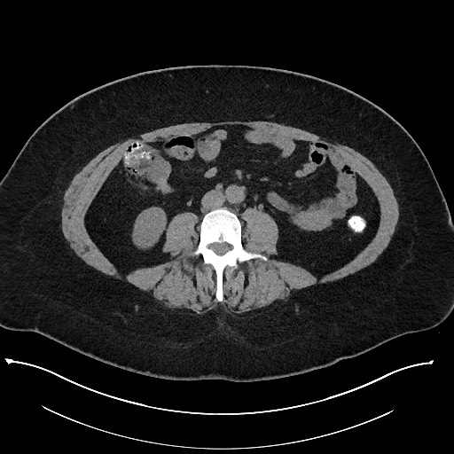 Carcinoid tumor - terminal ileum (Radiopaedia 60931-68740 Axial non-contrast 63).jpg