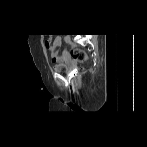 File:Carcinoma cervix- brachytherapy applicator (Radiopaedia 33135-34173 D 70).jpg