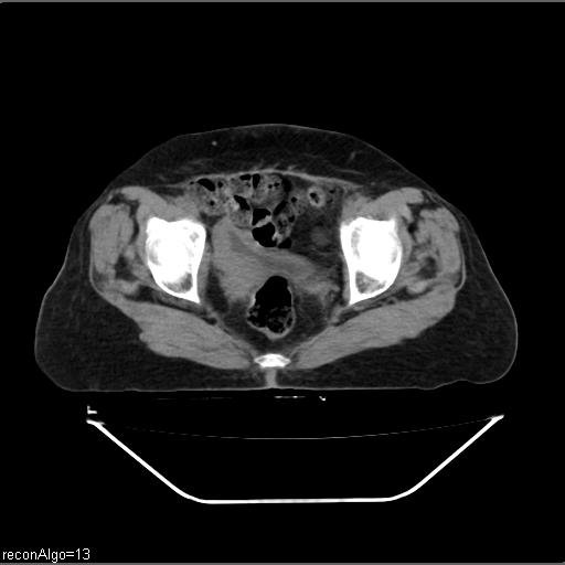 File:Carcinoma cervix- recurrence (Radiopaedia 34702-36137 Axial non-contrast 47).jpg