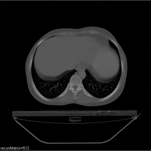File:Carcinoma of esophagus (Radiopaedia 27356-27550 Axial bone window 9).jpg