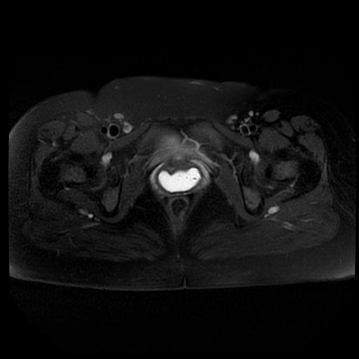 File:Carcinoma of the cervix (Radiopaedia 89018-105858 Axial T2 fat sat 14).jpg