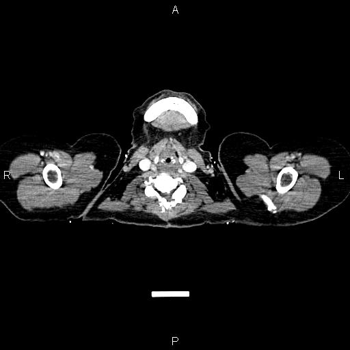 File:Carcinoma of uterine cervix (Radiopaedia 85861-101700 A 2).jpg