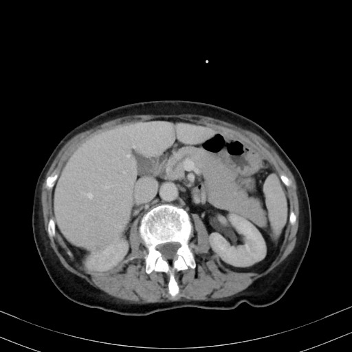 Carcinosarcoma (Radiopaedia 70401-80503 A 23).jpg