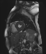 Cardiac amyloidosis (Radiopaedia 51404-57150 Sagittal CINE SSFP 158).jpg