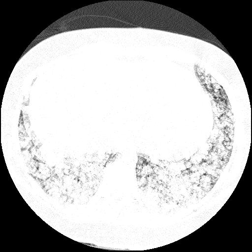 Cardiac angiosarcoma (Radiopaedia 66010-75181 Axial lung window 9).jpg