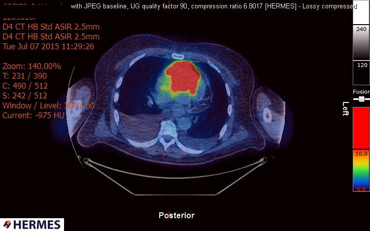 File:Cardiac lymphoma (Radiopaedia 38690-40871 Integrated PET-CT 11).jpg