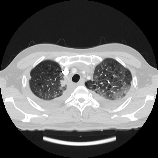 Cardiac tamponade (Radiopaedia 78607-91368 Axial lung window 12).jpg