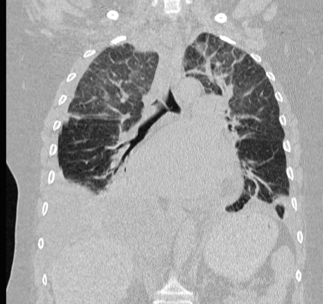 Cardiogenic pulmonary edema (Radiopaedia 29213-29609 Coronal lung window 38).jpg