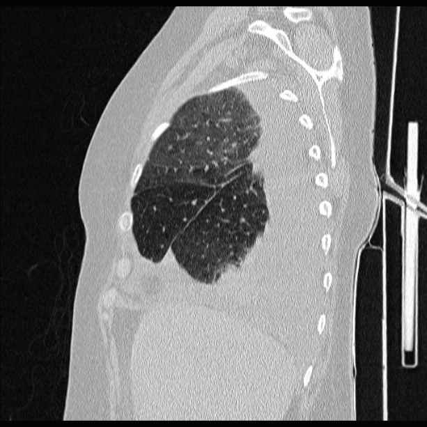 Cardiogenic pulmonary edema (Radiopaedia 29213-29609 Sagittal lung window 21).jpg