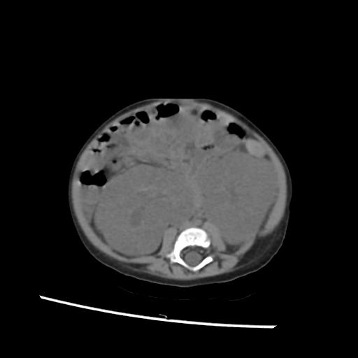 File:Caroli disease with autosomal recessive polycystic kidney disease (ARPKD) (Radiopaedia 89651-106703 Axial non-contrast 37).jpg