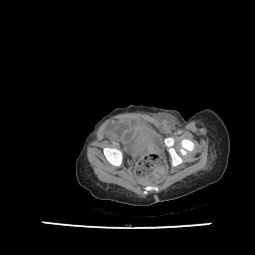 Caroli disease with autosomal recessive polycystic kidney disease (ARPKD) (Radiopaedia 89651-106703 B 209).jpg