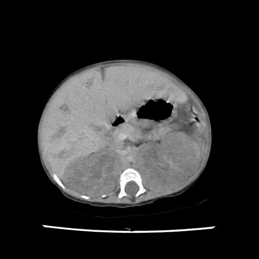 Caroli disease with autosomal recessive polycystic kidney disease (ARPKD) (Radiopaedia 89651-106703 B 84).jpg