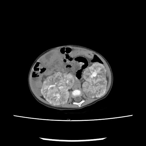 Caroli disease with autosomal recessive polycystic kidney disease (ARPKD) (Radiopaedia 89651-106703 E 123).jpg