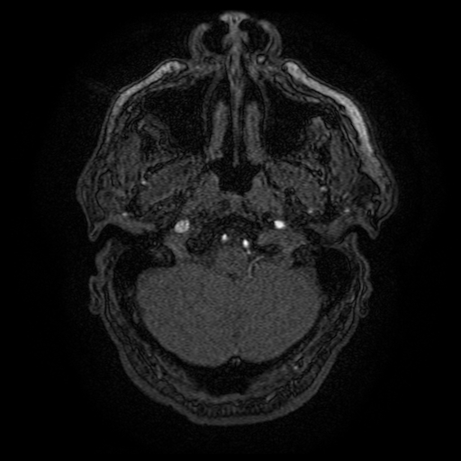 Carotid arterial dissection with acute cerebral infarction (Radiopaedia 26636-26784 MRA 153).jpg