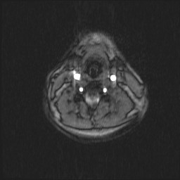 File:Carotid artery dissection (Radiopaedia 28441-28689 Axial MRA 37).jpg