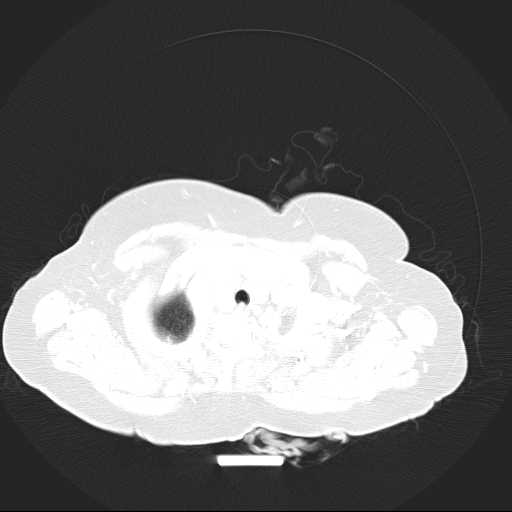 File:Carotid body tumor (Radiopaedia 21021-20948 Axial lung window 1).jpg