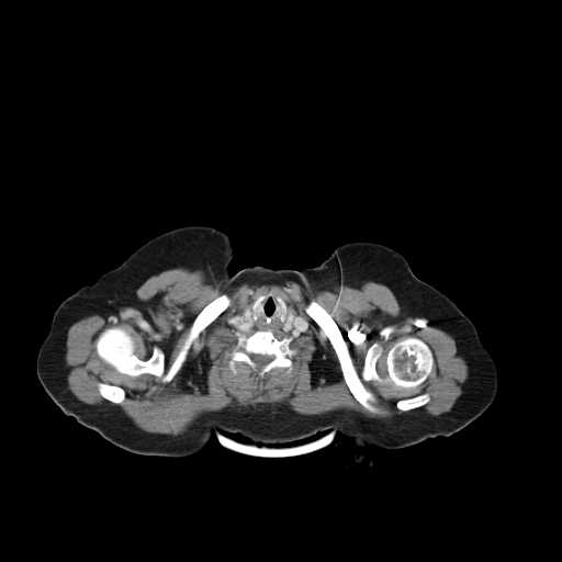 File:Carotid body tumor (Radiopaedia 21021-20948 B 20).jpg