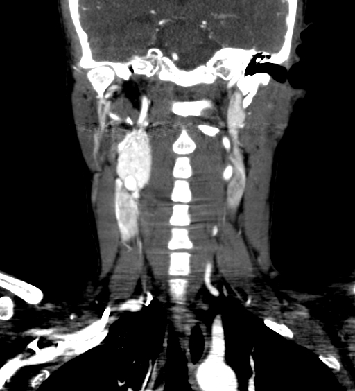 File:Carotid body tumor (Radiopaedia 39845-42300 C 45).jpg