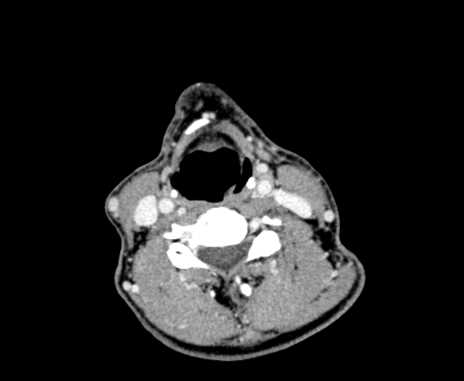 Carotid body tumor (Radiopaedia 61750-69757 Axial Post contrast 66).jpg