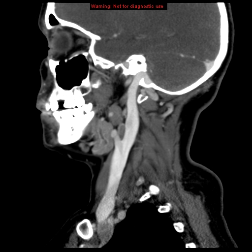 Carotid body tumor with lung metastases (Radiopaedia 9301-9986 Sagittal C+ delayed 15).jpg
