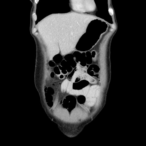 Castleman disease with fibrous pseudotumor in the abdomen (Radiopaedia 77296-89373 B 19).jpg