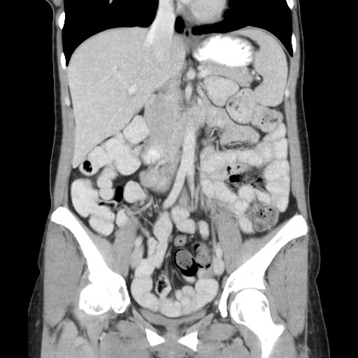 File:Castleman disease with fibrous pseudotumor in the abdomen (Radiopaedia 77296-89373 B 44).jpg