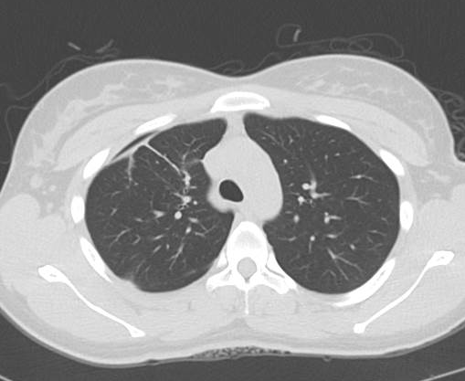 File:Catamenial pneumothorax (Radiopaedia 54382-60600 Axial 29).png